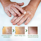 Sumifun Vitiligo Care Cream 20g | Botanical Skin Care Cream | Daily Skin Moisturizing Formula | External Use Cream