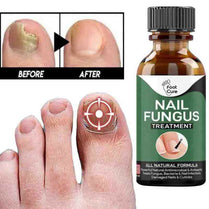 Nail Fungus Solution – All-Natural Treatment for Discolored & Damaged Nails (Fingernails & Toenails)