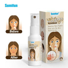 Sumifun Vitiligo Skin Care Spray 20ml | Botanical Skin Care Mist | Even Tone Skin Care Formula | External Use Skin Spray