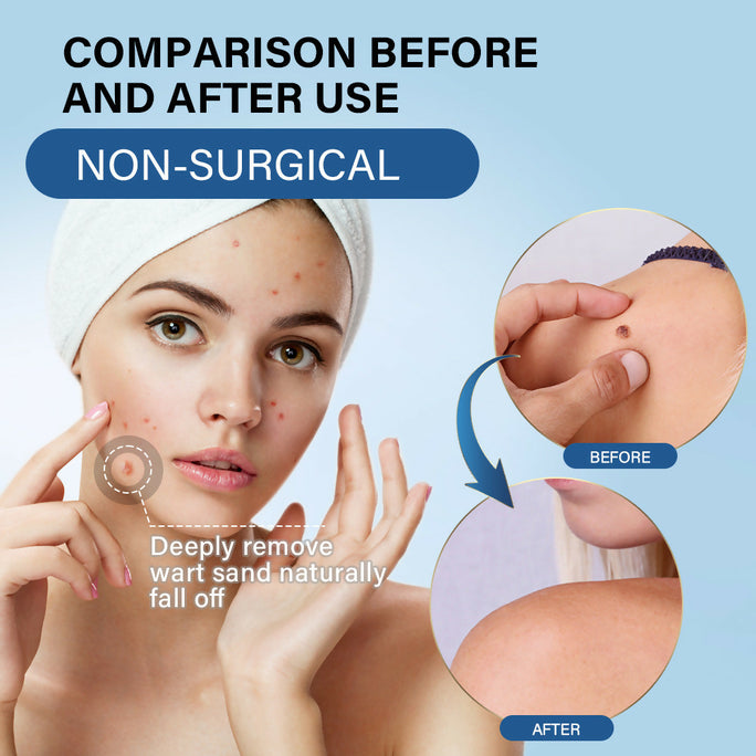 Sumifun Warts Remover Antibacterial Cream Skin Tag Removal Oil Wart Treatment