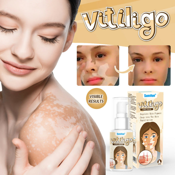 Sumifun Vitiligo Care Cream 30ml | Pigmentation Care Cream | Botanical Skin Care Formula | Daily Skin Care | External Use